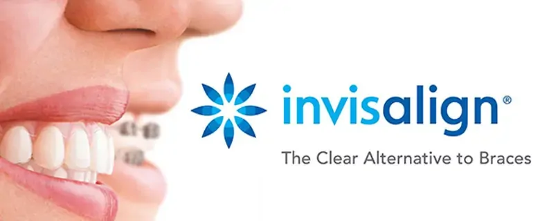 How Long Does Treatment With Invisalign Typically Take?